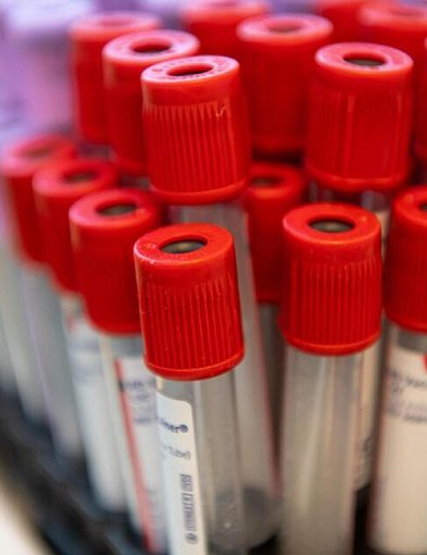 Obniżenie cholesterolu to tysiące mniej zawałów i udarów-54819